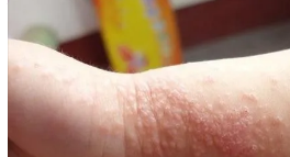儿童湿疹症状