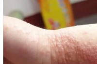 儿童湿疹症状