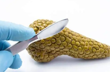 生物标志物有望识别胰腺癌的早期风险
