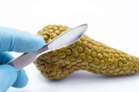 生物标志物有望识别胰腺癌的早期风险