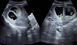 怀双胞胎初期有什么明显症状