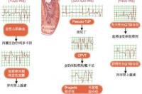 造成猝死的主要原因是 儿茶酚胺敏感性室速