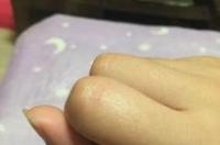 被狗狗的牙齿划破皮了咋办？ 被幼犬牙齿划伤出血了