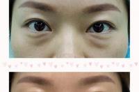 如何快速去眼袋简单方法 怎样去除眼袋