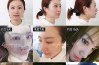硅胶隆鼻能保持一辈子吗？ 硅胶隆鼻可以一辈子不取出来吗