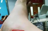 原矛头蝮能吃吗？ 原矛头蝮咬过后