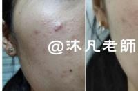 药店最有效的祛斑药膏 药店祛斑的6种药膏