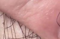 阴虱病是怎么回事？ 阴虱