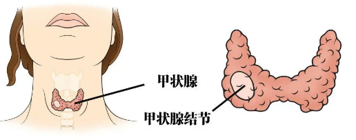 放射性碘或手术与甲状腺功能亢进患者的生存率增加有关