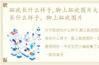 跖疣长什么样子,脚上跖疣图片大全，跖疣长什么样子，脚上跖疣图片