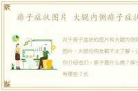 痱子症状图片 大腿内侧痱子症状图片