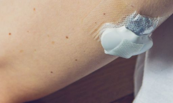 Omnipod 5胰岛素系统报告小数点故障